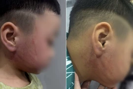 Công an xác minh vụ bé 4 tuổi nghi bị giáo viên mầm non đánh bầm tím mặt