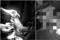 Nối thành công ca đứt rời bàn chân ở Quảng Trị