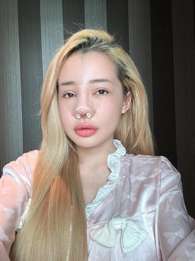 Nữ DJ cho biết ban đầu chỉ nghĩ đó là cục mụn ở mũi, tuy nhiên sau khi khám mới biết là bị nhiễm trùng nặng.