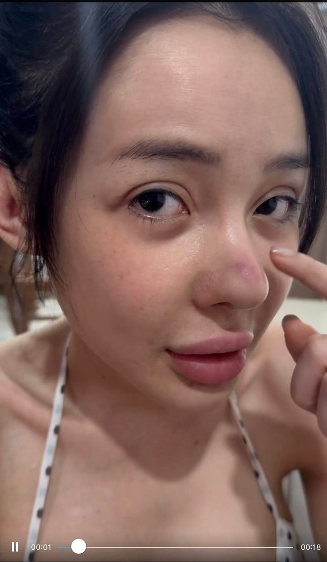 Nhiều người bày tỏ sự quan ngại cho tình trạng sức khỏe của Ngân 98 khi đang điều trị nhiễm trùng nặng ở mũi nhưng lại vô tư ăn hải sản. Trong hải sản có chứa nhiều dưỡng chất bổ dưỡng cho cơ thể. Tuy nhiên, nếu như đang có vết thương thì loại thực phẩm này lại không hề tốt. Việc ăn đồ tanh hoặc hải sản sẽ gây ra sự khó chịu, ngứa ngáy cho vết thương.