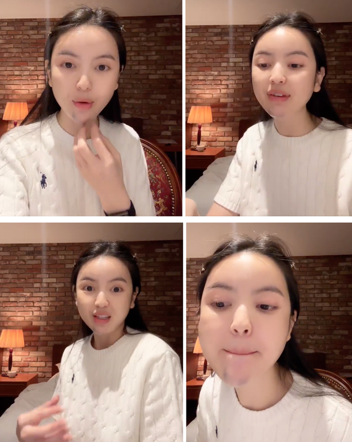 Cũng từ bức ảnh trên, netizen nhanh chóng "soi" ra phần cằm của cô có màu sắc bất thường, tím tái và có phần sưng nhẹ.