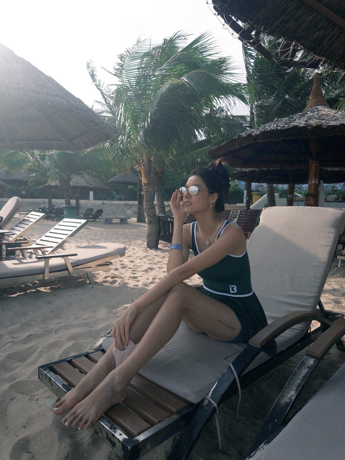 Đáng chú ý, sau phẫu thuật gãy xương đùi đã để lại sẹo dài trên chân của Kỳ Hân.