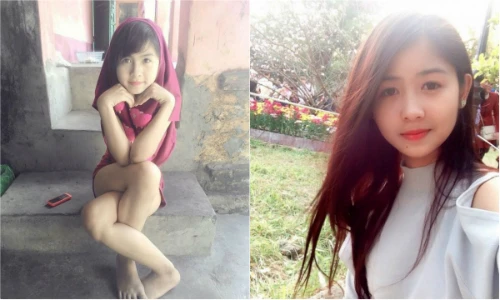 Bất ngờ với nhan sắc thay đổi của hot girl chân khoèo