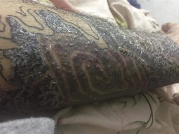 "Rợn tóc gáy" hình ảnh khách hàng bị nhiễm trùng, mưng mủ do xăm mực "dởm"