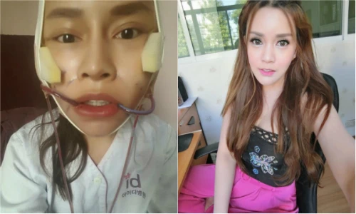 Hot girl Thái khoe ảnh phẫu thuật thẩm mỹ gớm ghiếc