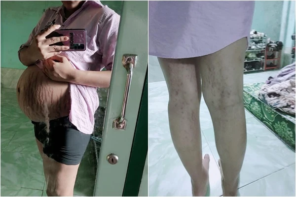 Hội chị em khoe ảnh bụng bầu nứt người, nhìn mà xót xa