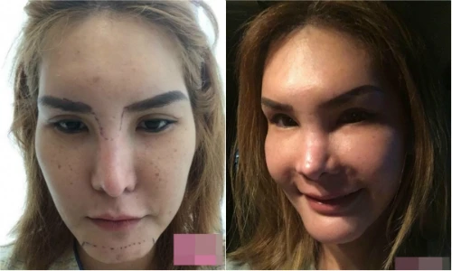 Phát hoảng với cô gái Thái “đập mặt đi xây lại“