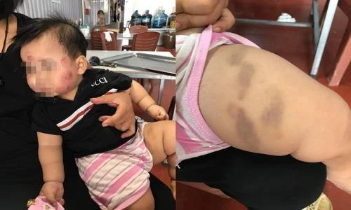 Bà mẹ tố nhà trường bạo hành trẻ em, dân mạng gay gắt lên tiếng