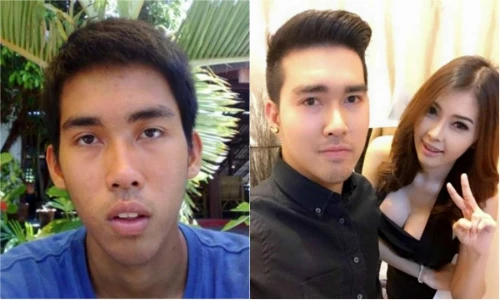 Trai quê xấu xí lột xác thành hot boy dao kéo