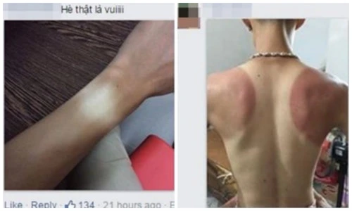 Dân mạng lên Facebook than nóng, khoe ảnh cháy nắng