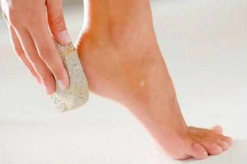 Mẹo vàng trị phồng rộp chân khi đi du lịch