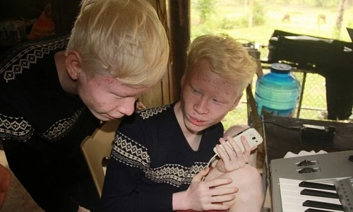 Xúc động ước mơ làm ca sỹ của anh em sinh đôi bị bạch tạng