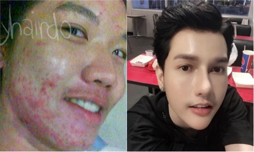 Bị bạn gái chê “mặt mụn”, chàng trai Thái quyết tâm lột xác