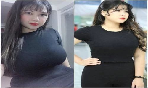 Sau khi làm phẫu thuật, nữ sinh ngực khủng Hải Dương giờ ra sao?