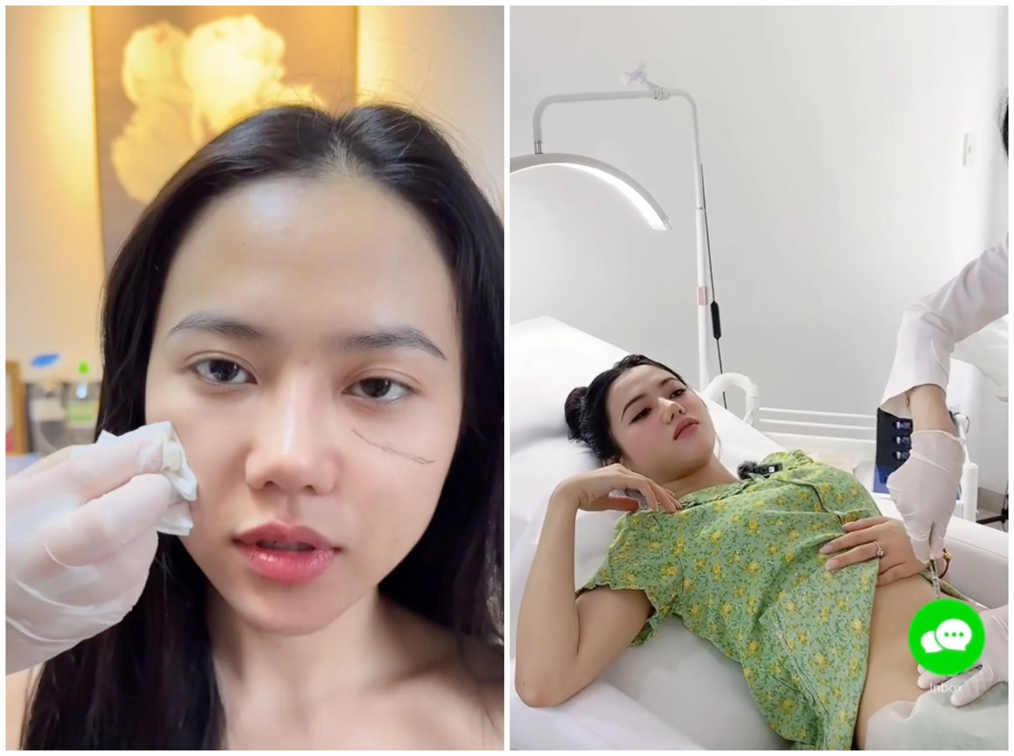 TikToker Bò Chảnh công khai thẩm mỹ, vị trí chỉnh sửa ở đâu?