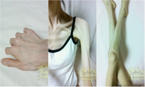 Bàng hoàng cô gái như “bộ xương di động” nặng 27 kg