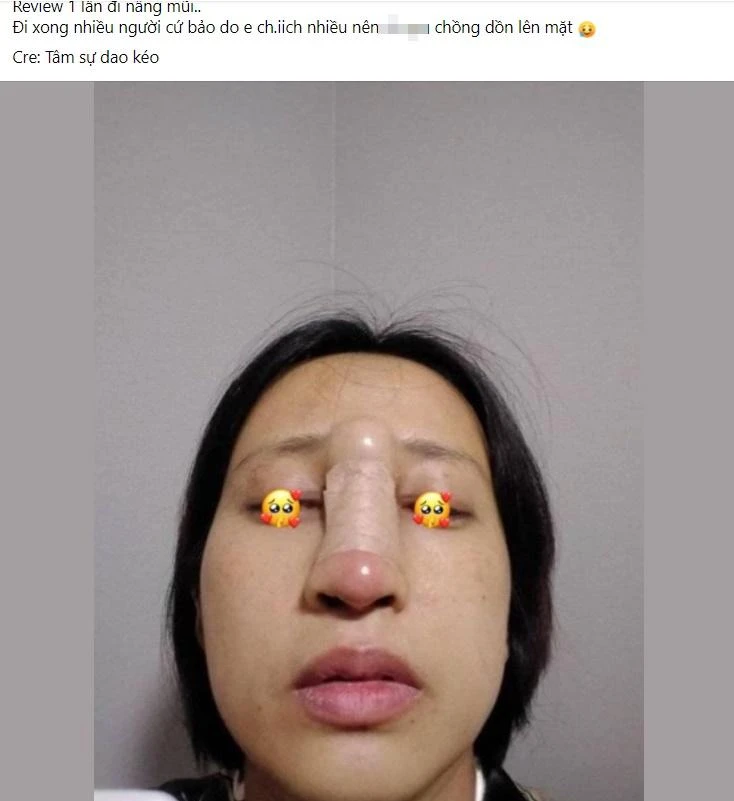 Cô gái gây hãi hùng khi nhìn thành quả của màn nâng mũi