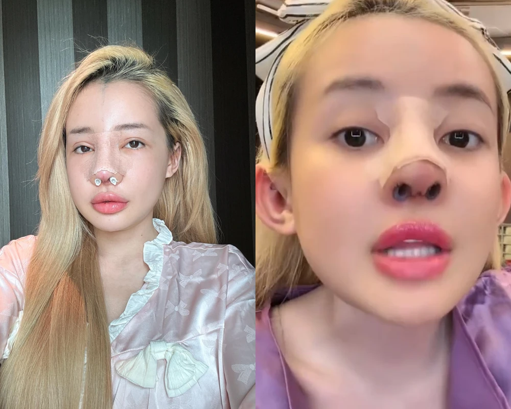 "Nghiện" phẫu thuật thẩm mỹ, Ngân 98 lại chuẩn bị "đập đi xây lại"