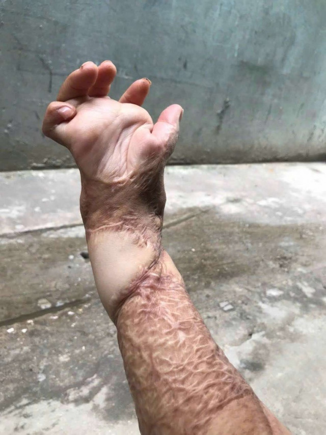 Người vợ 8 năm vượt qua cơn ác mộng bị chồng tưới xăng đốt - Hình 3 Nguoi vo 8 nam vuot qua con ac mong bi chong tuoi xang dot-Hinh-3