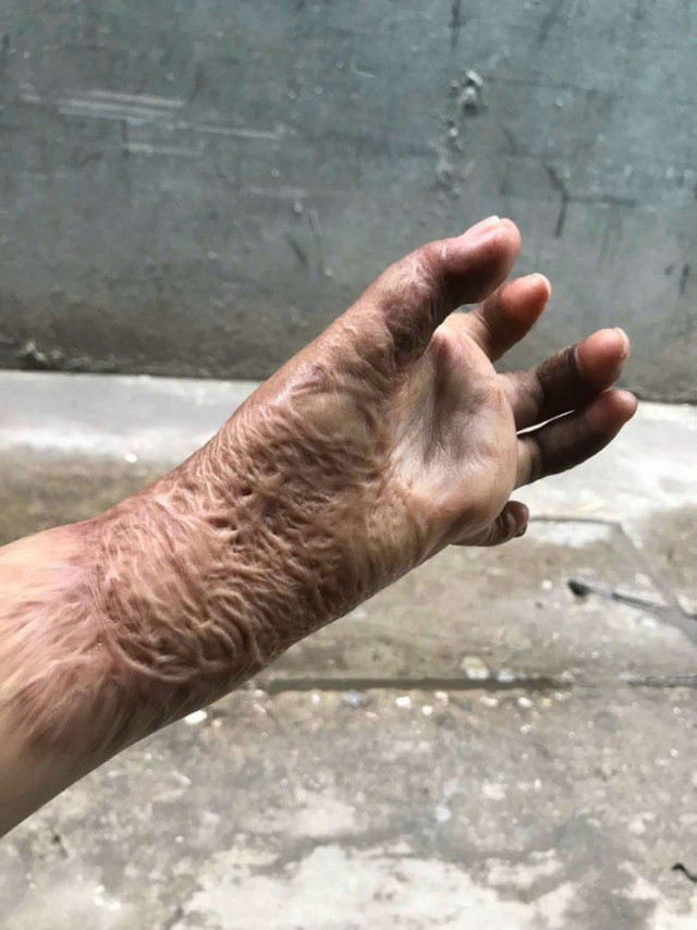 Người vợ 8 năm vượt qua cơn ác mộng bị chồng tưới xăng đốt - Hình 2 Nguoi vo 8 nam vuot qua con ac mong bi chong tuoi xang dot-Hinh-2
