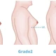 50 - 70% nam giới có dấu hiệu vú to, chớ nên chủ quan