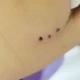 Trẻ 10 tuổi viêm tấy bàn tay do chuột cắn