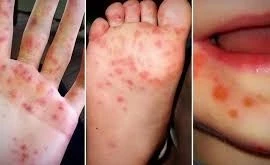 Vĩnh Long khẩn trương khống chế 5 ổ dịch tay chân miệng trong cộng đồng