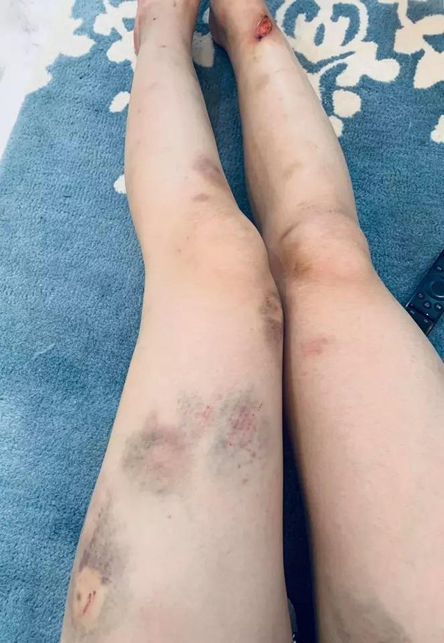 Tóc Tiên, Phương Oanh khoe chân bầm dập - Hình 3 Toc Tien, Phuong Oanh khoe chan bam dap-Hinh-3