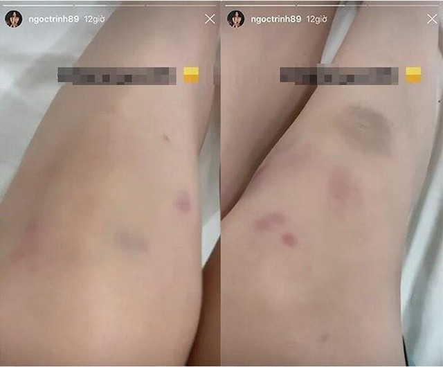 Tóc Tiên, Phương Oanh khoe chân bầm dập - Hình 4 Toc Tien, Phuong Oanh khoe chan bam dap-Hinh-4