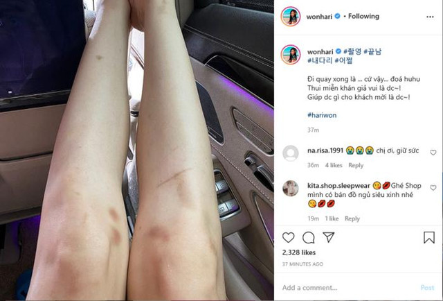 Tóc Tiên, Phương Oanh khoe chân bầm dập - Hình 6 Toc Tien, Phuong Oanh khoe chan bam dap-Hinh-6