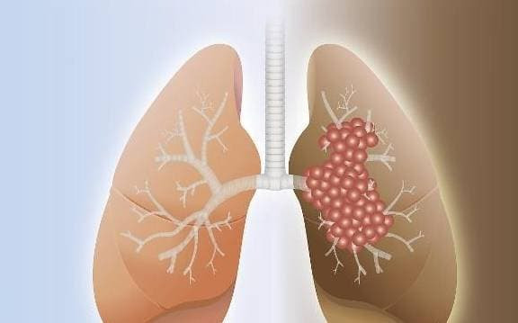 Trong giai đoạn đầu của ung thư phổi, tín hiệu này có thể xuất hiện Trong giai doan dau cua ung thu phoi, tin hieu nay co the xuat hien