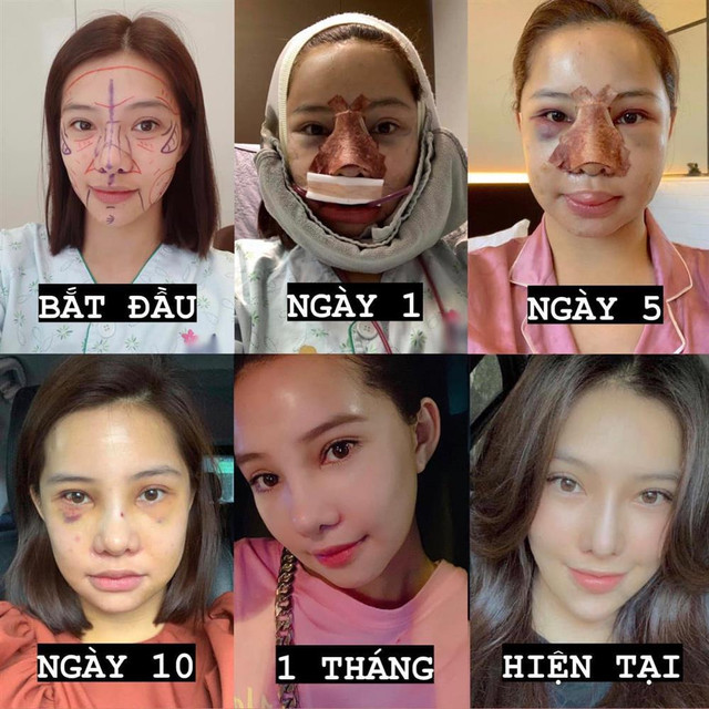 Ngoại hình hiện tại Lưu Đê Ly sau 3 năm sang Hàn thẩm mỹ - Hình 5 Ngoai hinh hien tai Luu De Ly sau 3 nam sang Han tham my-Hinh-5