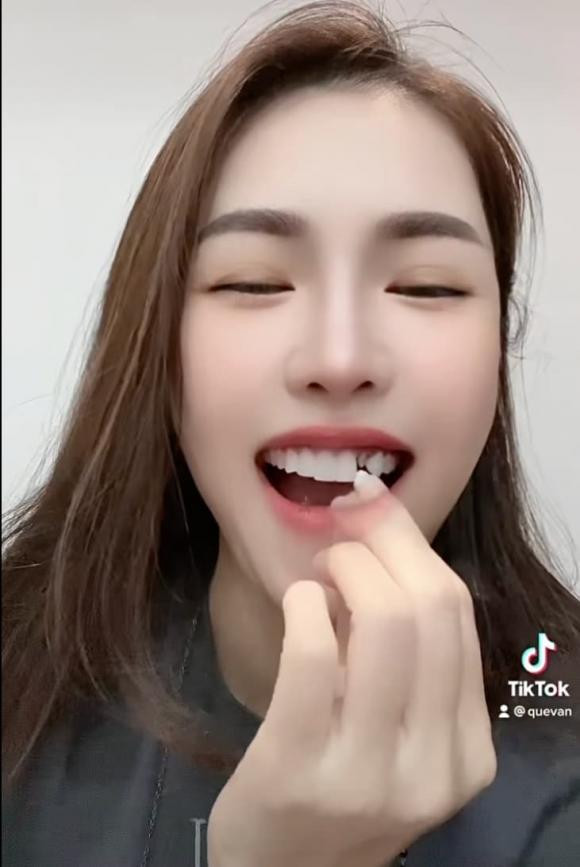 Quế Vân rụng răng sứ trông "dở khóc dở cười" - Hình 2 Que Van rung rang su trong