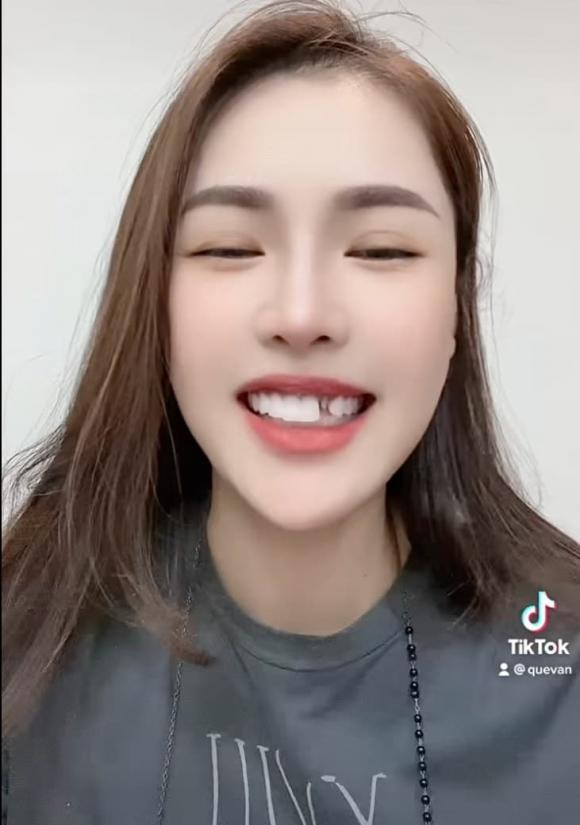 Quế Vân rụng răng sứ trông "dở khóc dở cười" Que Van rung rang su trong