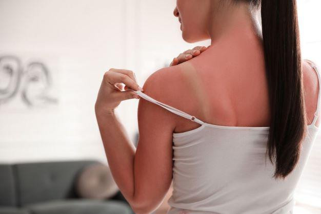 Mách bạn mẹo chữa cháy nắng hiệu quả Mach ban meo chua chay nang hieu qua