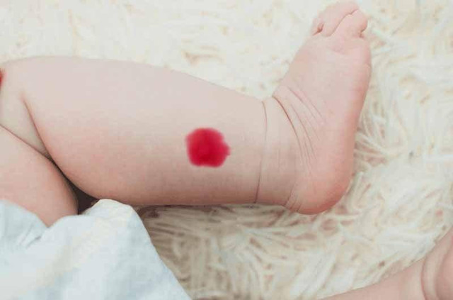 Vết bớt ở đâu 'đại vận khí'? - Hình 2 Vet bot o dau 'dai van khi'?-Hinh-2