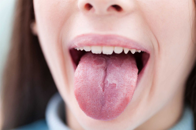 Dấu hiệu ở lưỡi cảnh báo bệnh nguy hiểm ảnh 1 Dấu hiệu ở lưỡi cảnh báo bệnh nguy hiểm ảnh 1