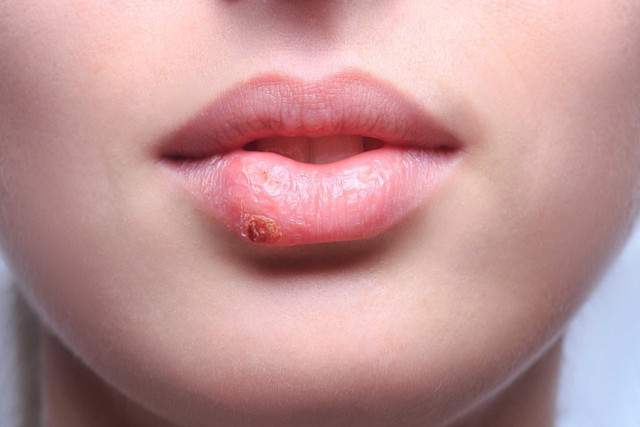 Chữa khỏi ung thư giai đoạn cuối nhờ loại virus quen thuộc Chua khoi ung thu giai doan cuoi nho loai virus quen thuoc