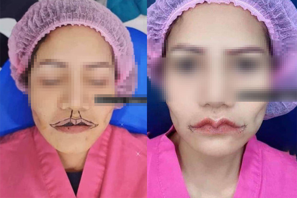 Hết hồn đôi môi 'Mazda' của cô gái trẻ sau phẫu thuật - Hình 3 Het hon doi moi 'Mazda' cua co gai tre sau phau thuat-Hinh-3