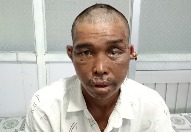Người đàn ông bị hành hạ trên tàu cá có tỷ lệ thương tích 48% Nguoi dan ong bi hanh ha tren tau ca co ty le thuong tich 48%