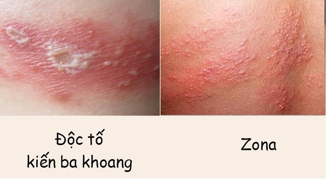 Độc tố kiến ba khoang gấp 15 lần rắn hổ mang - Hình 2 Doc to kien ba khoang gap 15 lan ran ho mang-Hinh-2