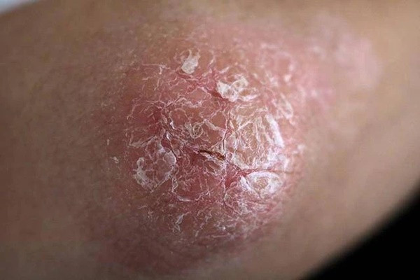 Mùa đông, ngâm chân nước ấm cực tốt nhưng lại cực hại vì điều này Mua dong, ngam chan nuoc am cuc tot nhung lai cuc hai vi dieu nay