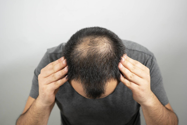 Phát hiện mới về cách điều trị hói đầu cho nam giới Phat hien moi ve cach dieu tri hoi dau cho nam gioi
