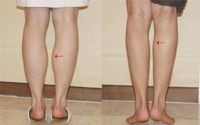 Mách bạn cách giảm mỡ bắp chân cực kỳ dễ Mach ban cach giam mo bap chan cuc ky de