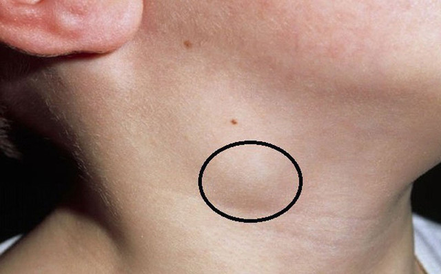 6 dấu hiệu chứng tỏ sức đề kháng yếu, dễ bị virus tấn công 6 dau hieu chung to suc de khang yeu, de bi virus tan cong