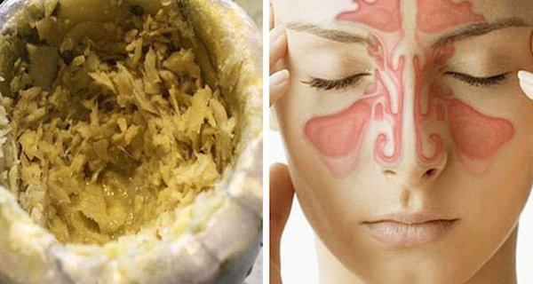 5 cách chữa viêm xoang bằng gừng tươi: Đỡ hẳn dịch mủ 5 cach chua viem xoang bang gung tuoi: Do han dich mu