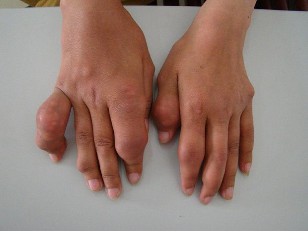 Căn bệnh "nhà giàu" gây đau đớn, mất ăn mất ngủ Can benh