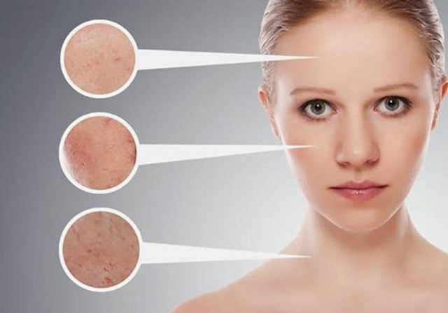Mẹo trị mụn từ các nguyên liệu tự nhiên và thói quen ngăn ngừa mụn mọc Meo tri mun tu cac nguyen lieu tu nhien va thoi quen ngan ngua mun moc