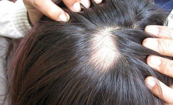 Vi sao không nên nhổ tóc bạc: 5 cái hại ai cũng cần biết - Hình 2 Vi sao khong nen nho toc bac: 5 cai hai ai cung can biet-Hinh-2
