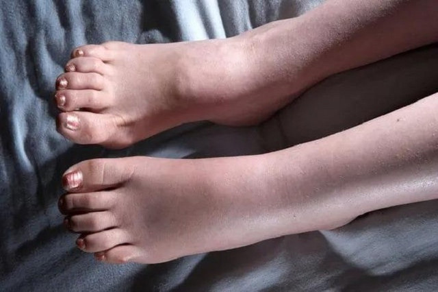 Dấu hiệu ở chân cảnh báo phổi của bạn đang gặp vấn đề. Ảnh minh họa